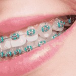 How Much Are Braces? A Complete Guide to Costs, Types, and Value